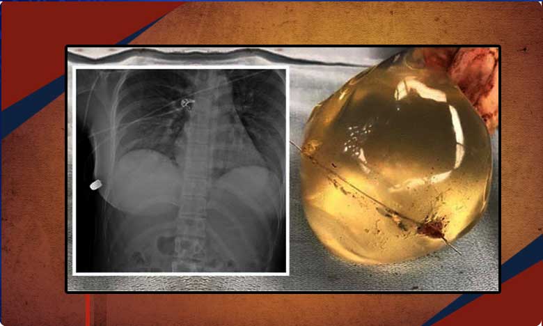 వ‌క్షోజాలే ఆమె ప్రాణాల‌ను నిలిపాయ్ Womans Breast Implant Deflects