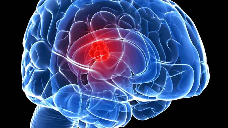 Brain Tumor 