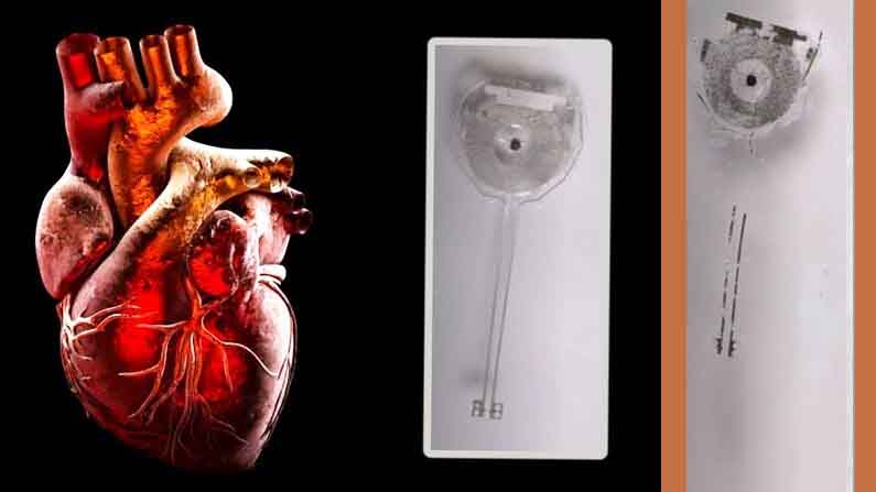 Tempo Maker: Scientists create battery-operated short-term pacemaker – Tempo Maker Worlds first tempo maker for coronary heart sufferers which is labored and not using a battery