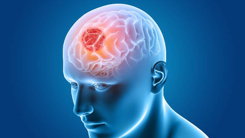 Brain Tumor: తలనొప్పి ఎక్కువ రావడం బ్రెయిన్ ట్యూమర్‌కు సంకేతమా? ఇది  క్యాన్సర్‌గా మారుతుందా? తెలుసుకోండి! - Telugu News | Is over headache a  sign for Brain Tumor can brain ...